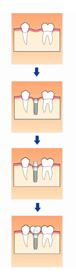 インプラント（人工歯根）治療の流れ