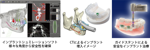 インプラント（人工歯根）治療の流れ